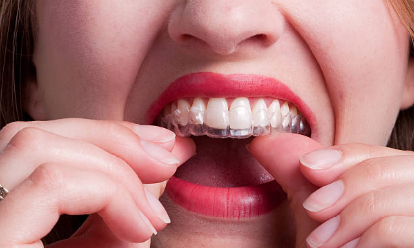 5 Reasons To Choose Clear Aligners