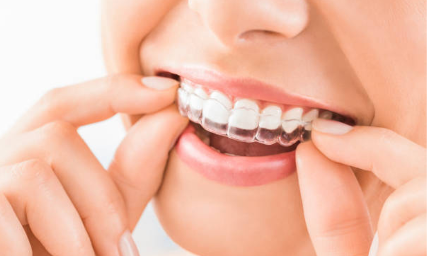 Can I switch to clear braces even when undergoing metal braces treatment?