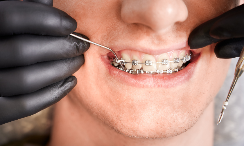 Warning Signs That You Need Braces in The Woodlands