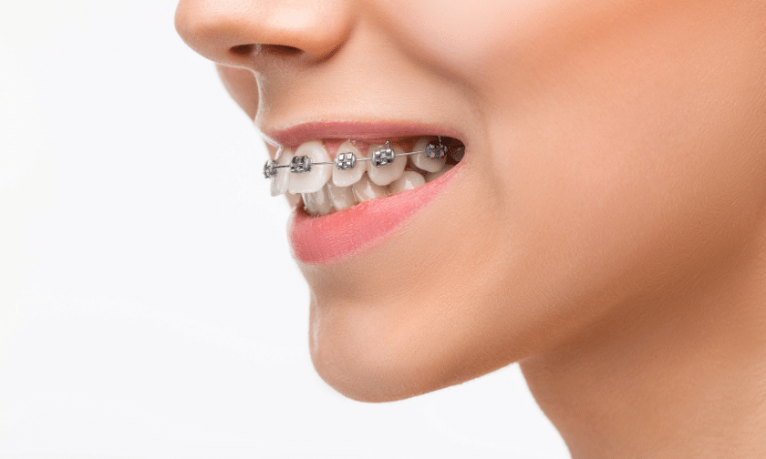How To Care For Your Teeth While Wearing Braces