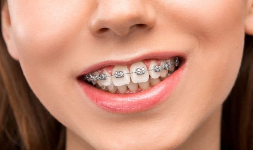 Life With Braces: Tips For Eating, Brushing, And Flossing
