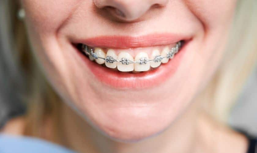 Clear Braces Vs. Clear Aligners: Which Option Is Right For You?