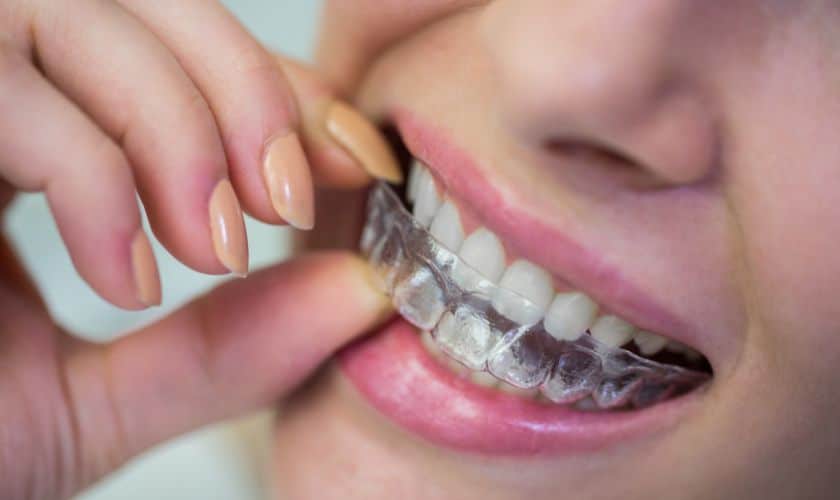 Maintaining Good Oral Hygiene While Using Invisalign