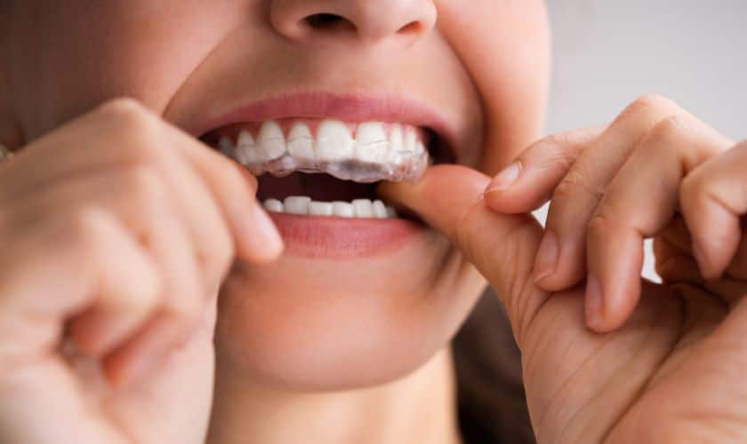 How Clear Aligners Work To Correct Misaligned Teeth?