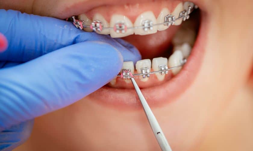 9 Signs To Get Your Child Braces