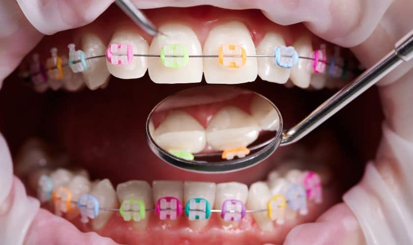 How to Help Your Teen Cope With Orthodontic Treatment