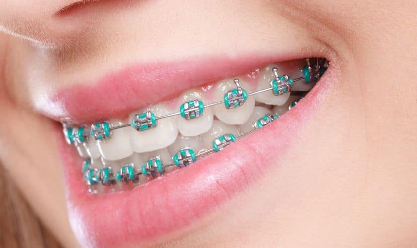 Festive Smiles: Christmas Care Tips For Braces Wearers