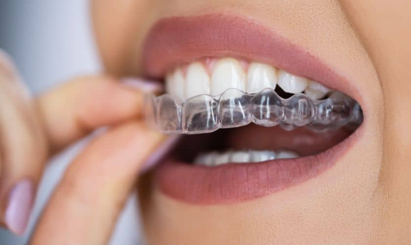What To Avoid When Cleaning Your Clear Aligners?