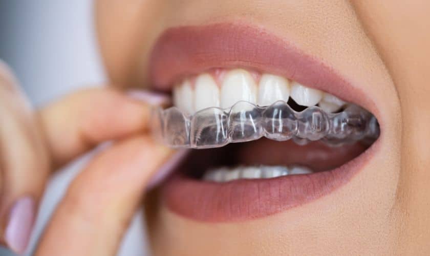 How Do Clear Aligners Improve Adults’ Oral Health?